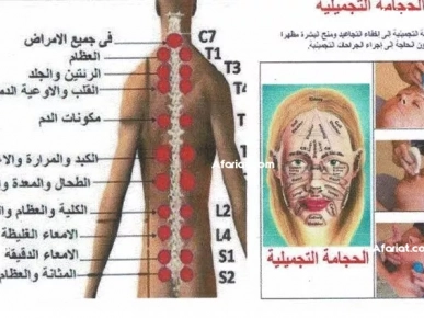 Le traitement par ventouses “Al- Hijama”